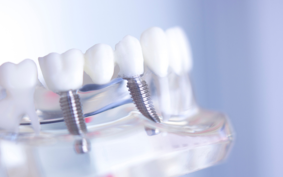 Dental Implants: Single vs Multiple Treatment Options