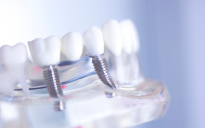 Dental Implants: Single vs Multiple Treatment Options