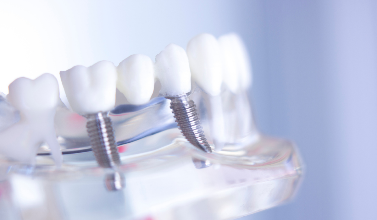 Dental implants treatment planning comparison at Pavilion Dentistry showing single tooth versus multiple implant restoration options