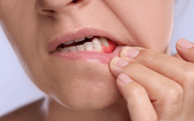 Dental Implants: Gum Disease Treatment Guide