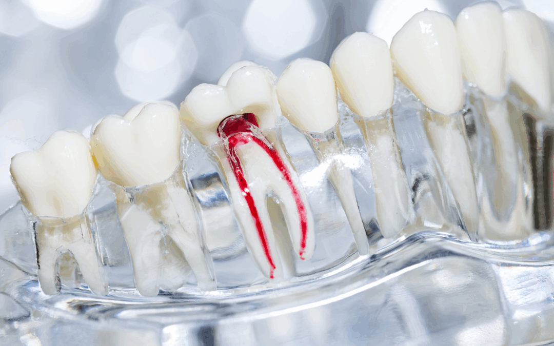 Dentist in St. Catharines: Root Canal Treatment Guide