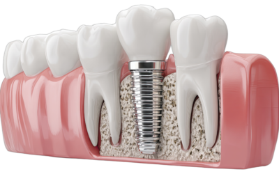 Dental Implants Failure: Warning Signs and Prevention Strategies