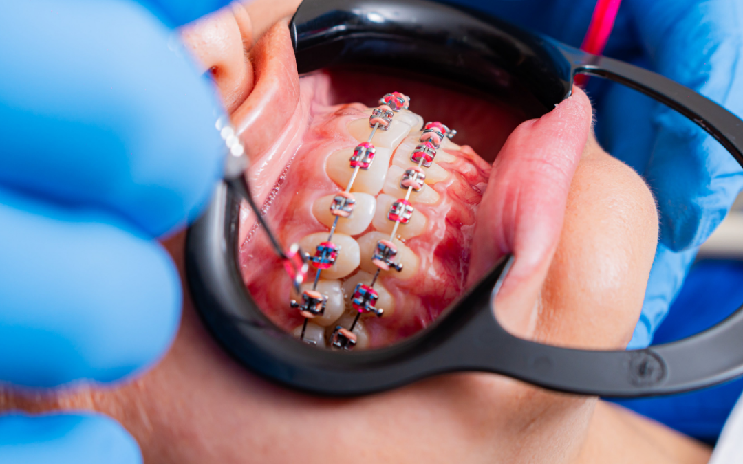 Braces Removal Process: What to Expect on Your Final Orthodontic Day
