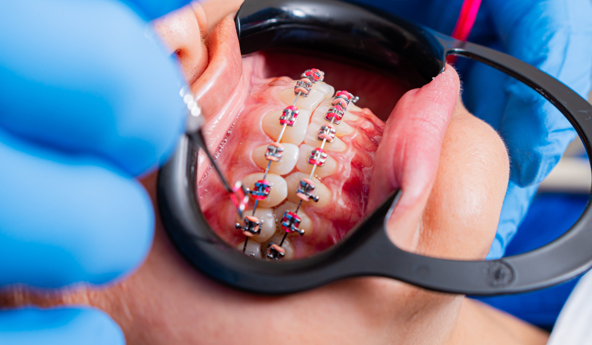 Braces removal process at Pavilion Dentistry St. Catharines