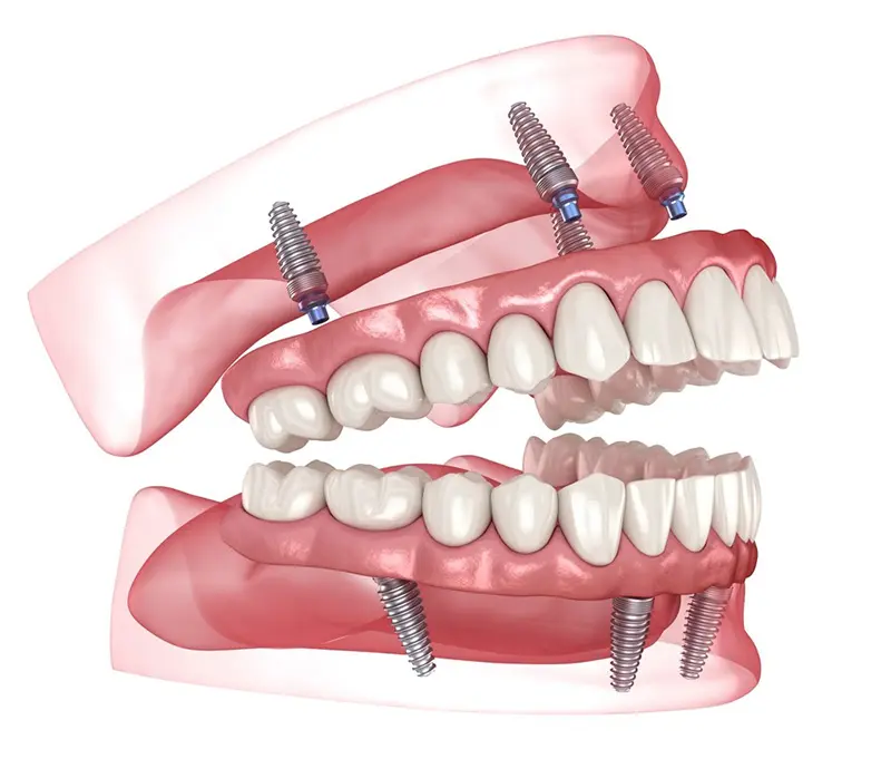 All-on-X in St. Catharines full arch restoration at Pavilion Dentistry